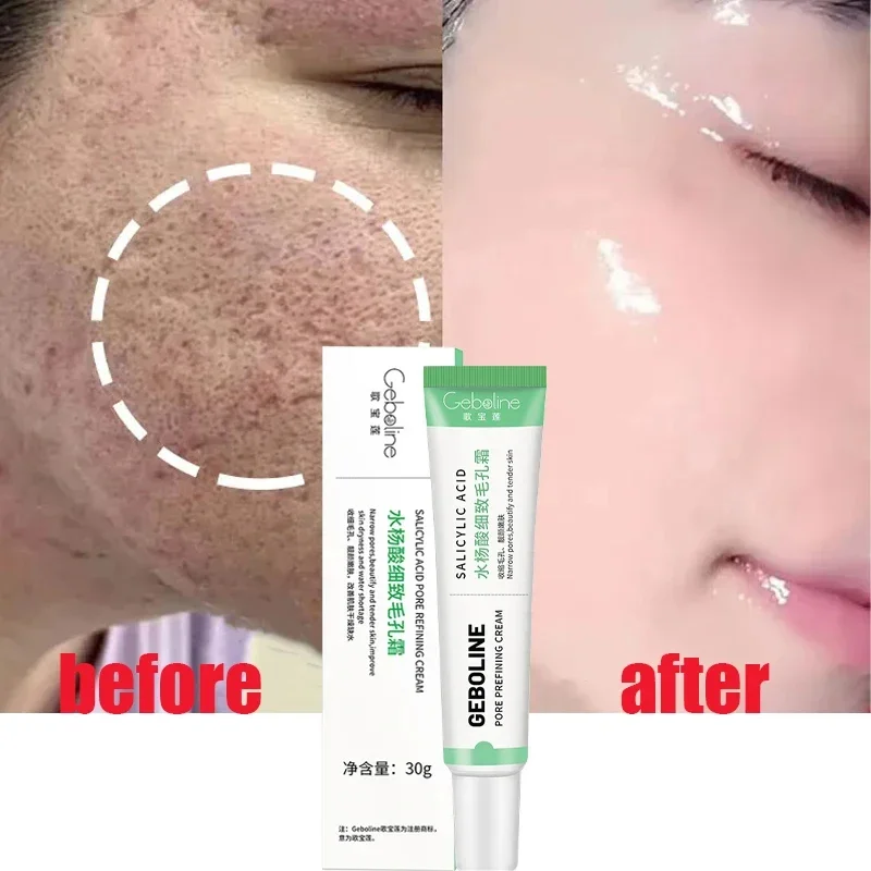 Skincare Salicylic Acid - Krim Kecilkan pori asam salisilat penghilang